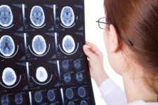 Effects of Brain Injuries